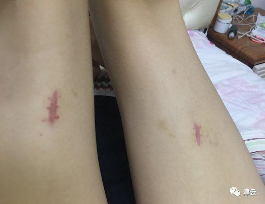 目前的现状，伤口处留下伤疤