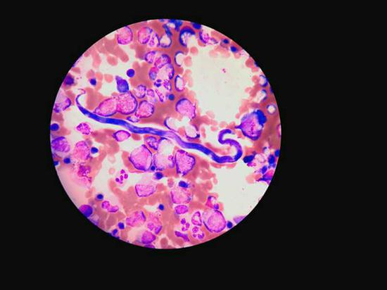 多见于非洲中西部地区的“罗阿丝虫”在显微镜下的形态。 本文图均为 瑞金医院 供图