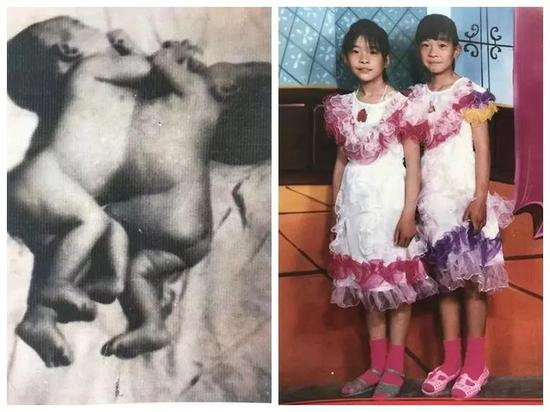 健康成长的联体婴儿