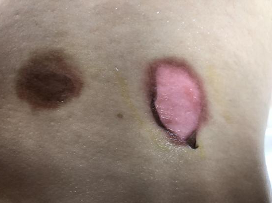 ↑7月13日，贴完“三伏贴”后，吴敏的孩子被灼伤