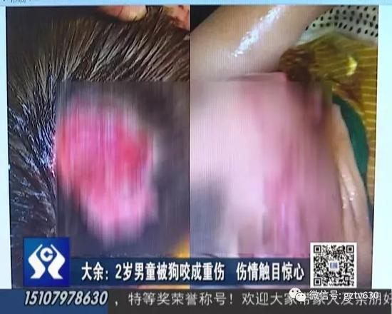　　近日，大余县青龙镇长里村一位2岁多的男孩成成，遭到村里一只狗的疯狂撕咬，导致头部面颊被咬开多个口子，狗主人竟然不承认。