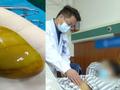 女子10年来天天不吃早餐 胆囊长出“土鸡蛋”吓坏家人