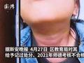 安徽小学老师泼热水烫伤十多名学生:还用脚踩学生的脸