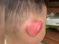 山东1岁萌娃被蚊虫叮成大耳朵图图:耳朵痒得非常难受