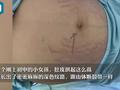 13岁女生肚子隆起爬满“妊娠纹”,照完CT妈妈当场吓懵
