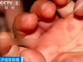 印度暴发番茄热疫情超80名儿童感染 当地卫生部门:与新冠无关