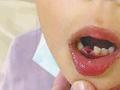 医生将8岁女孩恒牙当乳牙错拔 一查无独立执业资质