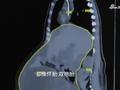 广州一女子腹部长31斤肿瘤被误认怀孕 医生:像是怀了双胞胎
