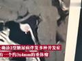 漂亮女子突然体重暴增变丑查出脑瘤 ,医生:不常见,只能手术解决
