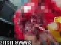 27岁患者元宵放炮不慎将手掌炸掉,目前正在手术中