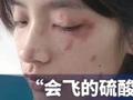 隐翅虫被称为飞行的硫酸:见到千万别打!小心毁容