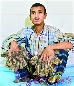 阿布尔手脚上巨大的树皮状疣子有望被切除。