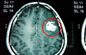 男孩脑中有半米长寄生虫 需花数十万手术将其吸出