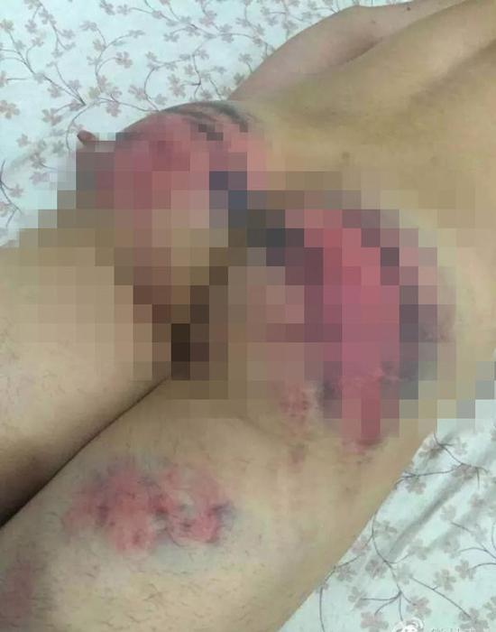 大学生遭打受伤