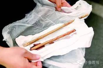 医生从小曲头部取出的竹竿。生活日报记者王鑫摄
