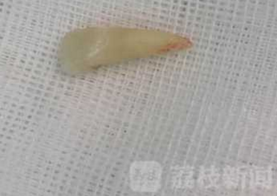 术后取出的牙齿