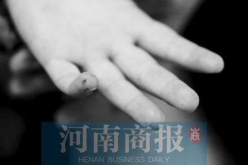 每天都要扎针测血糖，孩子的手上、脚上都是针眼。河南商报记者 侯建勋/摄