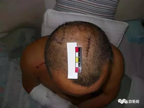 （受害人头上至今仍留有伤疤）