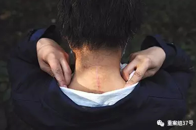 　　▲去年10月13日，延庆，在八达岭老虎咬人事件中受伤的赵菁（化名）首次露面讲述伤情。资料图片/新京报记者 薛珺 摄