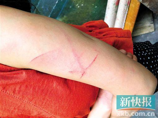 阿雯手臂上的伤痕清晰可见。&nbsp;受访者供图