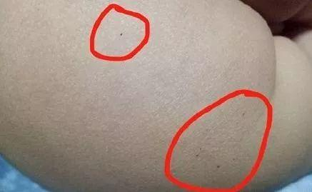 △涉事红黄蓝幼儿园被扎儿童身上的针孔（儿童家长供图）