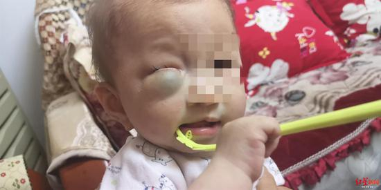 胡先生的小孙女（眼部和唇部存在畸形）