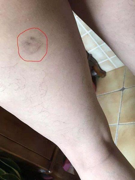 图说：半年多过去了，刘先生腿上的伤疤仍清晰可见 来源/采访对象供图