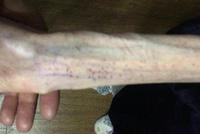 21岁女孩减肥至50斤 2次脑出血脑组织如60岁(图)