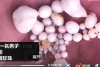 意外惊喜 加拿大男子吃牡蛎吐出48颗珍珠