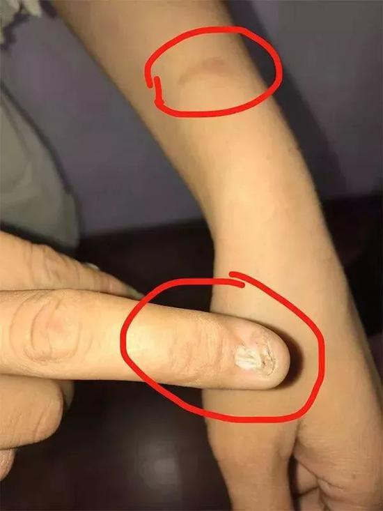 小琴被“刘叔”打的伤 葛亚琪 摄