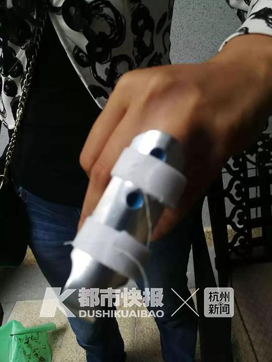 徐女士受伤的左手无名指。图片来源 都市快报