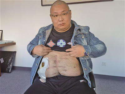 　　11月23日，邱绍春向新京报记者展示他的手术疤痕，在第二次手术前他只能依靠造口袋排泄。新京报记者 李照 摄