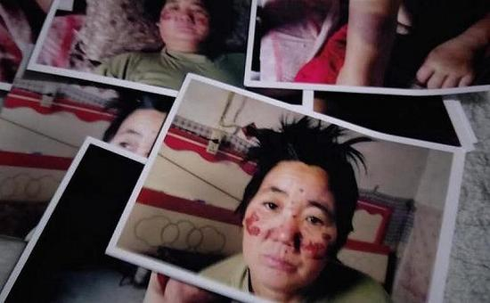 王秀娥拍摄的证据，她被打得伤痕累累。摄影：刘成伟。