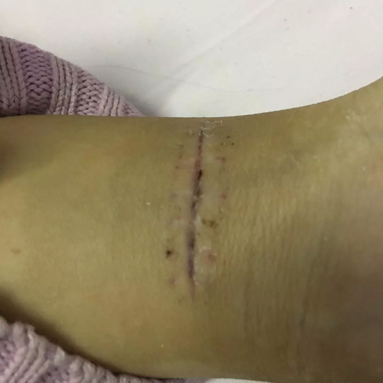 小凡割腕后的伤痕仍然清晰可见