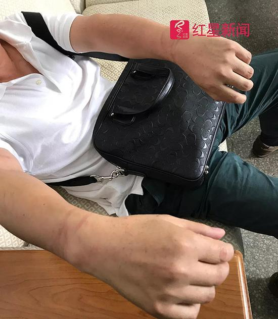 付成受伤。 红星新闻 图