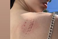 奚梦瑶拍广告后背勒伤 微博诉苦美丽背后不容易