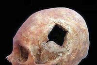 古代外科医学最为发达的地方,史前考古发现真相