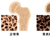 骨质疏松症的分类