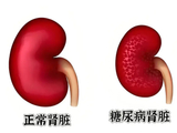 糖尿病肾病是怎样发生的？