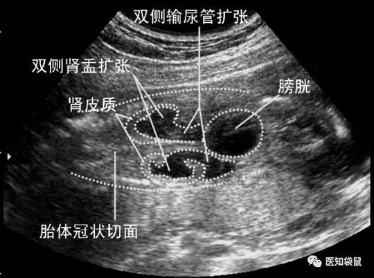 b超是准妈妈在孕期必须要做的产检项目,通过它可以了解胎儿发育的