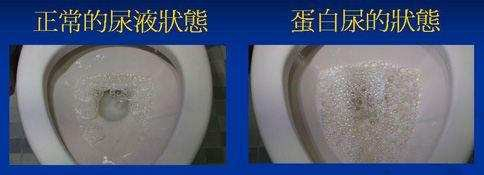 尿液中出现大量泡沫, 这些情况下是疾病引起的!