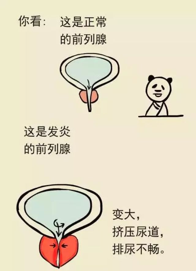 【健康】前列腺炎症,增生会变癌症吗?"男性生命线"这样保养!