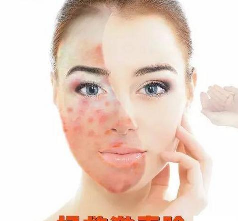 战胜激素性皮炎是需要“拒绝美丽”的勇气|护肤品|激素|性皮炎|化妆品|口周皮炎_新浪新闻