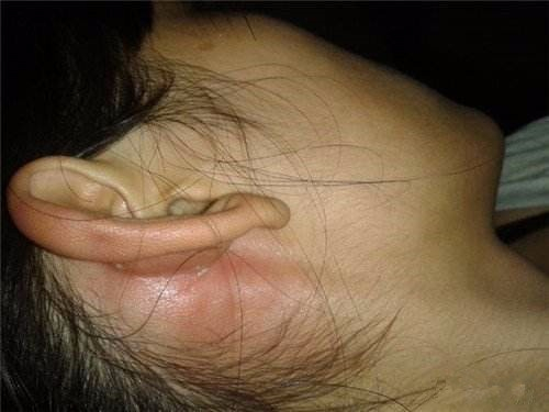 人耳后长疙瘩怎么回事?是淋巴被感染了,有的注意排毒
