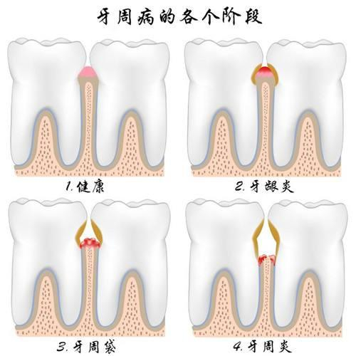 被10亿人忽视的牙周病也会致命?氢气能治疗牙周炎?