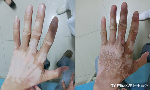 白癜风诊疗