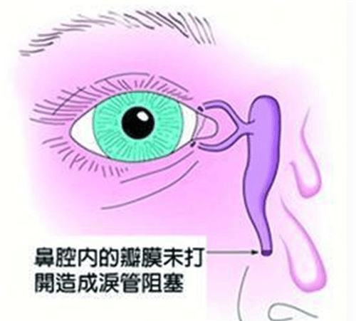 新生儿泪囊炎按摩手法图解 简单实用