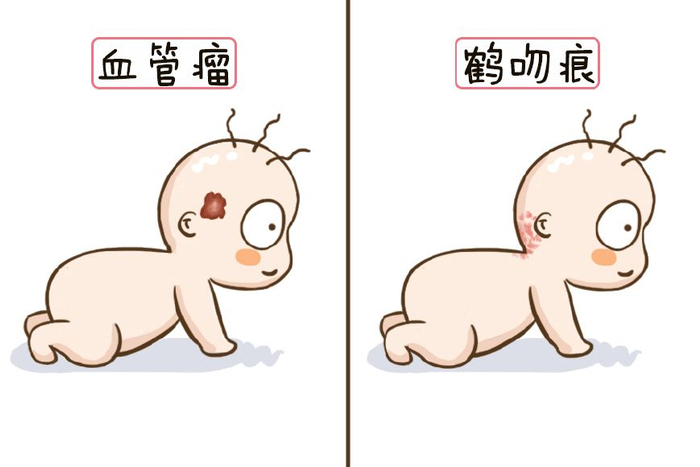 宝宝身上有胎记,宝妈们可不能放任不管,这样的胎记要尽早治疗