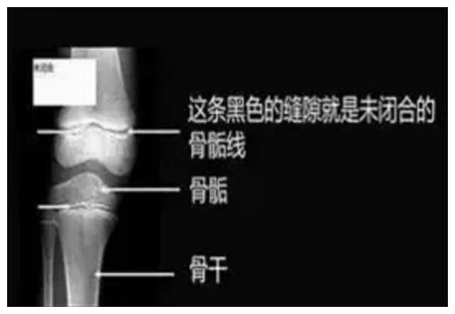 这3个坏习惯，会让孩子骨骺线提前闭合组长不高，家长要注意|骨骺线|发育|身高_新浪新闻