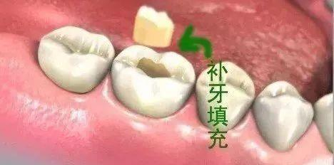 揭秘补牙全过程,看看牙医在你嘴里做了什么?